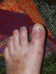 20 days after hobo spider bites.webp